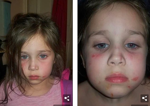 5歲的女孩臉上滿是瘀傷，原來(lái)在校車上被毆打了45分鐘