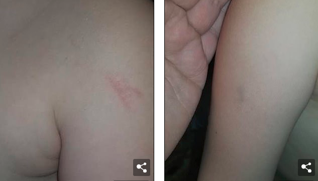 5歲的女孩臉上滿是瘀傷，原來(lái)在校車上被毆打了45分鐘